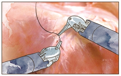 “机械手”助心脏病患者免除开胸锯骨之痛