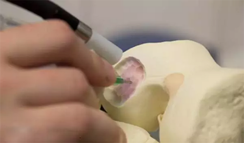 常州一医院应用3D打印技术成功治疗骨折